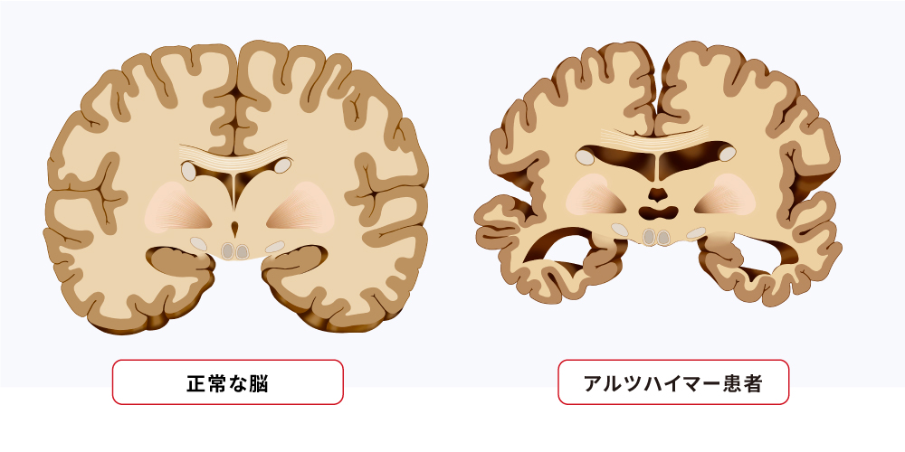 若年性アルツハイマー病とは何ですか?